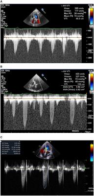 Case Report: Leaflet Thrombosis After Transcatheter Aortic Valve Replacement With Worsening Heart Failure—A Successful Resolution Using Non-vitamin K Antagonist Oral Anti-coagulant
